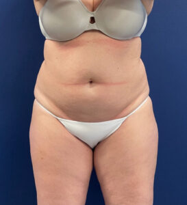 Case--24903 | Before Tummy Tuck 1