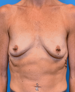 Case--22845 | Before Breast Augmentation With Lift 1