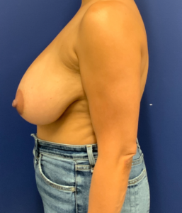 Breast-Reduction-Case--25560 | Before Dr. Wesley Price 2