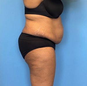 Lipoabdominoplasty-Case--255 | Before Liposuction 2