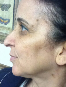 Case--36 | Before CPS Plastic Surgeons 2