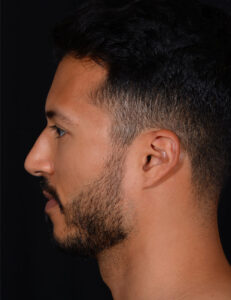 Rhinoplasty-Case--379 | Before Rhinoplasty for Men 2