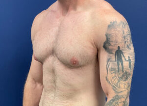 Case--28230 | Before Gynecomastia / Male Breast Reduction 2