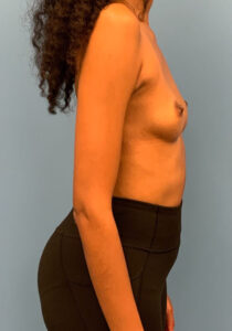 Case--26022 | Before Breast Augmentation 2