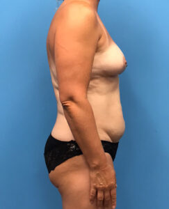 Case--139 | Before DIEP Flap 2