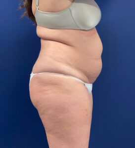 Case--24903 | Before Tummy Tuck 2