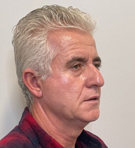 Case--291 | Before Facelift for Men 2