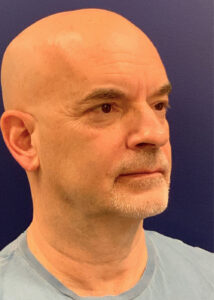 Case--22080 | Before Neck Lift 2