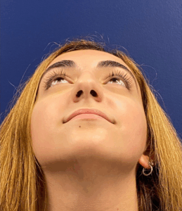 Rhinoplasty-Case--2537 | Before Rhinoplasty 2