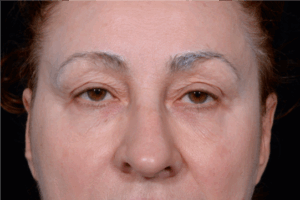 Blepharoplasty-Case--9685 | Before Eyelid Surgery 1