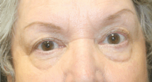 Blepharoplasty-Case--6005 | Before Eyelid Surgery 1