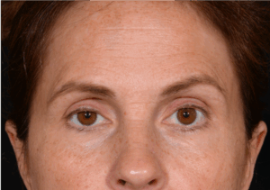 Quad-Blepheroplasty-Case--5361 | Before Eyelid Surgery 1