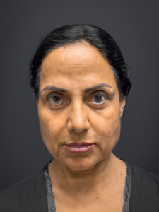 Facelift-Case--7062 | Before Facelift 1