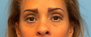 Quad-Blepharoplasty-Case--1261 | Before Eyelid Surgery 1
