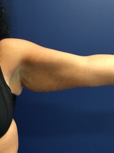 Brachioplasty-Case--1162 | Before Arm Lift 1