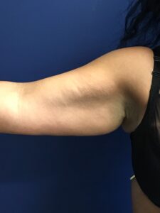 Brachioplasty-Case--1162 | Before Arm Lift 2