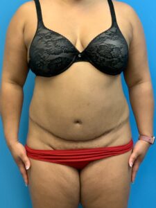 Abdominoplasty-Case--9870 | Before Tummy Tuck 1