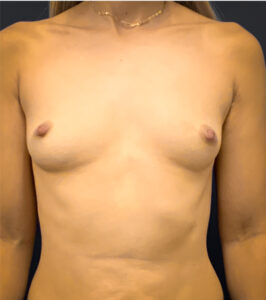 Breast-Augmentation-Case--8208 | Before Breast Augmentation 1