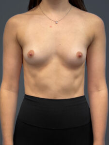 Breast-Augmentation-Case--6687 | Before Breast Augmentation 1