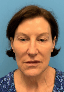 Case--6591 | Before Facelift 1