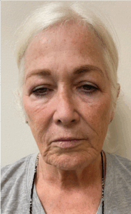 Facelift-Case--8874 | Before Facelift 1