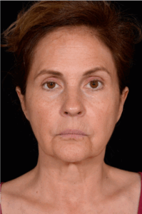 Facelift-Case--4160 | Before Facelift 1