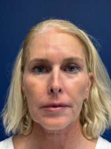 Facelift-Case--2253 | Before Facelift 1