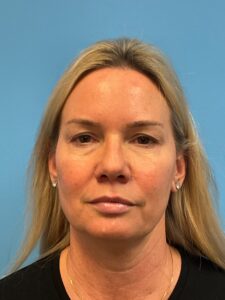 Quad-Blepharoplasty-Case--4265 | Before Eyelid Surgery 1