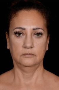 Facelift-Case--6496 | Before Facelift 1