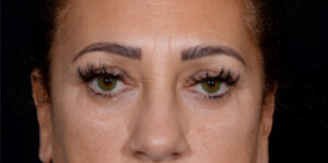 Quad-Blepharoplasty-Case--2302 | Before Eyelid Surgery 1