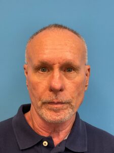 Facelift-Case--7592 | Before Facelift for Men 1