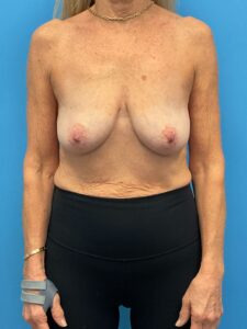 Mastopexy-Case--9216 | Before Breast Lift 1