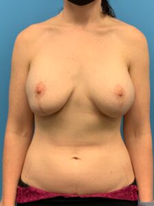 Implant-Removal-Case--6466 | Before Dr. Arjun Kanuri 1