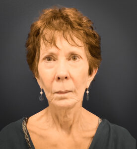 Facelift-Case--8727 | Before Facelift 1