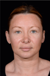 Facial-Fat-Grafting-Case--1679 | Before Facial Fat Grafting 1