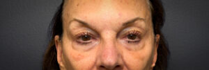 Upper-Blepharoplasty-Case--2075 | Before Eyelid Surgery 1