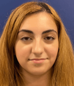 Rhinoplasty-Case--2537 | Before Rhinoplasty 1