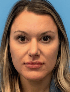 Rhinoplasty-Case--4972 | Before Rhinoplasty 1