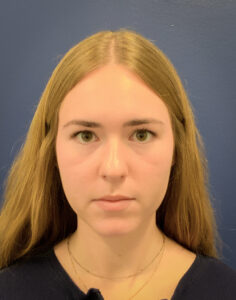 Rhinoplasty-Case--6484 | Before Rhinoplasty 1