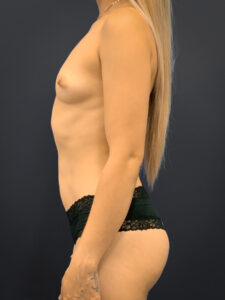 Breast-Augmentation-Case--5691 | Before Breast Augmentation 2