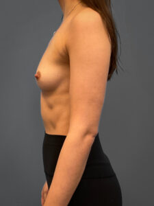 Breast-Augmentation-Case--6687 | Before Breast Augmentation 2