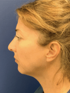 Facelift-Case--8368 | Before Facelift 2