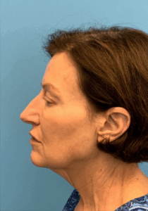 Case--6591 | Before Facelift 2