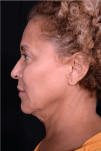 Face-and-Neck-Lift-Case--3772 | Before Neck Lift 2