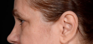 Quad-Blepharoplasty-Case--1851 | Before Eyelid Surgery 2