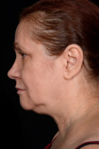 Facelift-Case--6254 | Before Facelift 2