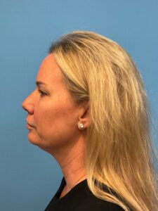 Quad-Blepharoplasty-Case--4265 | Before Eyelid Surgery 2