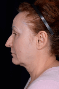 Face-and-Neck-Lift-Case--8423 | Before Neck Lift 2
