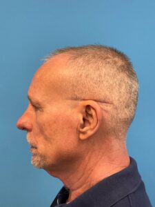 Facelift-Case--7592 | Before Facelift for Men 2