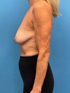 Mastopexy-Case--9216 | Before Breast Lift 2